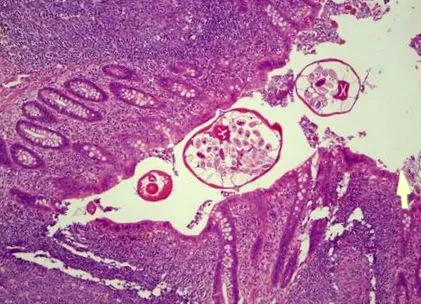 endometrium hyperplasia