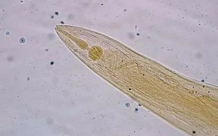 endometrium hyperplasia