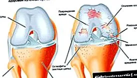 arthritis injekciók