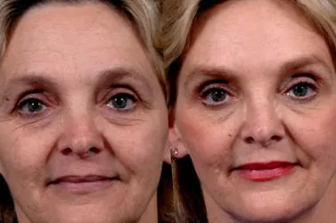 intraceuticals