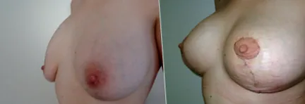 nagyobb implantátumok