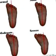 metatarsus varus