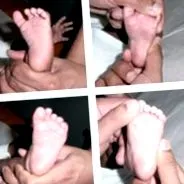 metatarsus