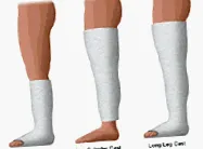 metatarsus