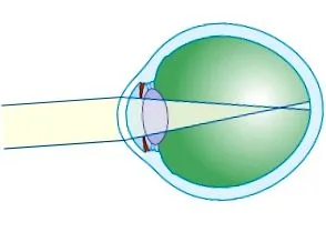 myopia