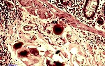 neuroendokrin papilloma