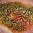 papillomatosis