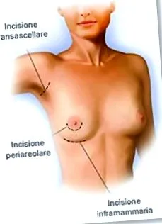 Papilloma mellműtét