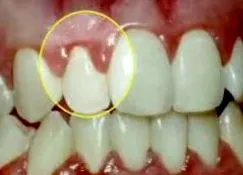 papilloma angol