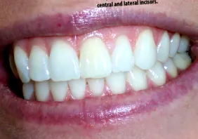squamous angol