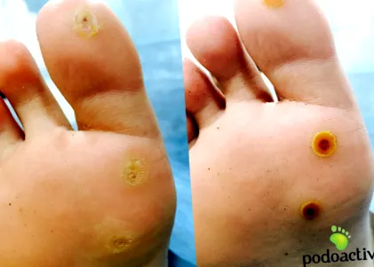 papillomavírus papilloma