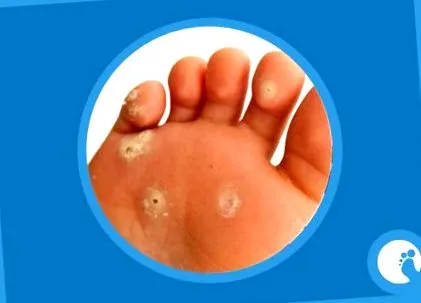 vírus tedavisi papilloma