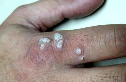 vírus papilloma