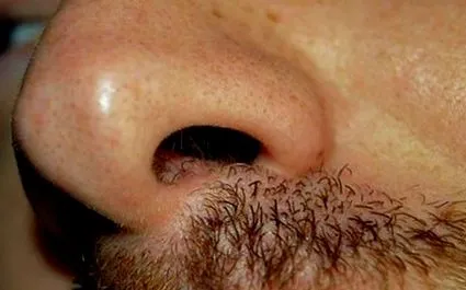 viso papilloma