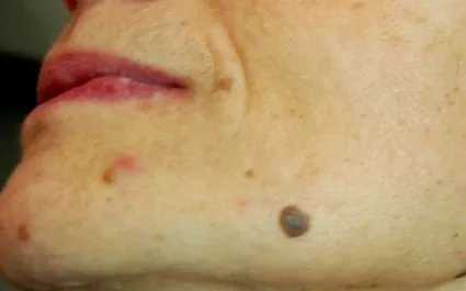 viso papilloma