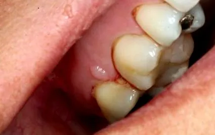 angol squamous