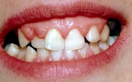 squamous angol