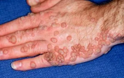 papilloma vírus alle