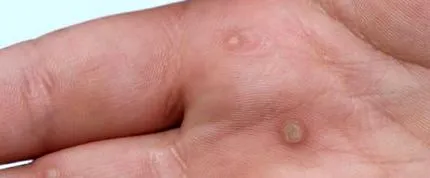 papilloma vírus