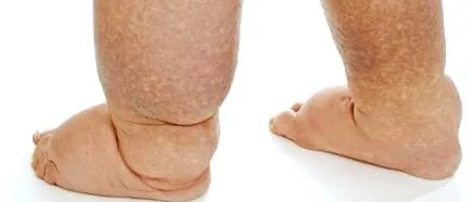 papillomatosis