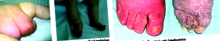 papillomatosis