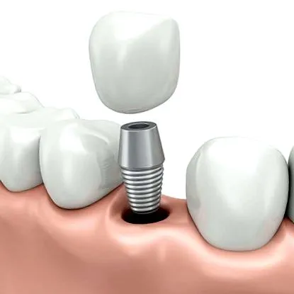 implantátumot