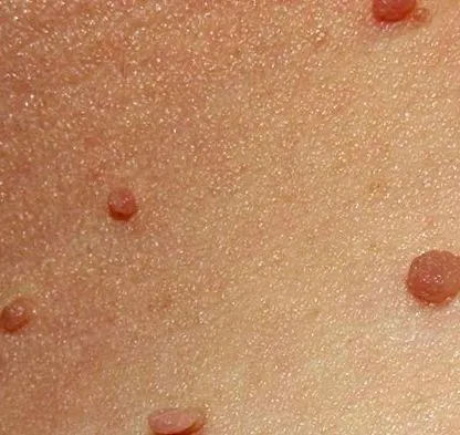 adenomatózus