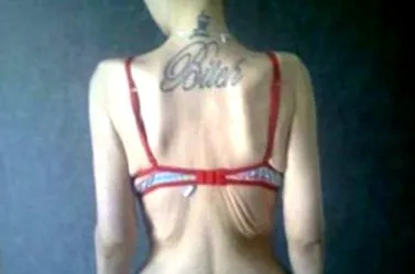 anorexiáig