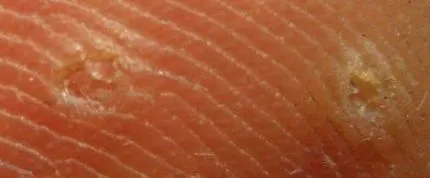 należy papillomavirus