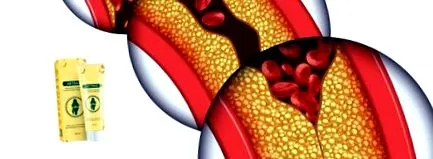 osteochondrosisban