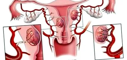 fibroidov