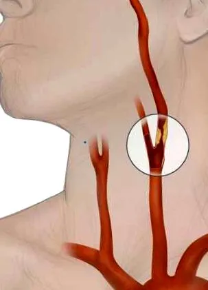stenosis