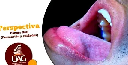 papilloma
