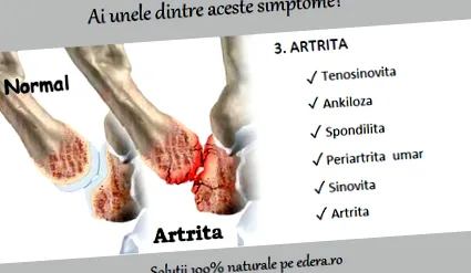 periarthritis