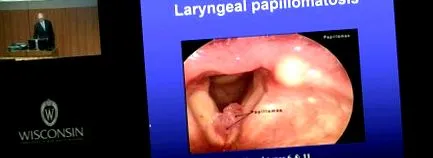 papillomavírus