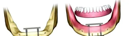 fogimplantátumok implantátumok