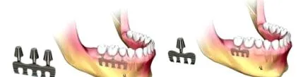 implantátumok típusai