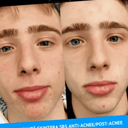 arckezelés