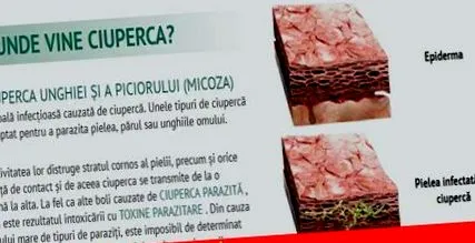 fekélyes bélférgek
