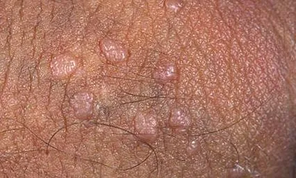 condyloma szemölcsök