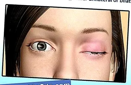 myasthenia