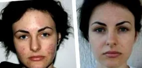 оние акни