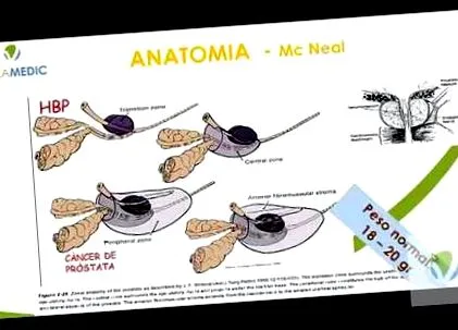 adenoma esetén prosztata adenoma