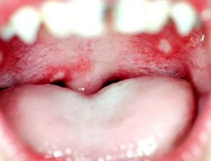 képek Canker