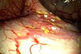 angiodysplasia angiodysplasia