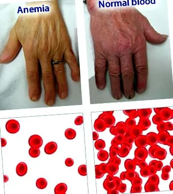 anemia