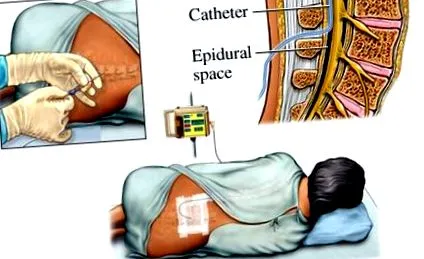 epidurális érzéstelenítés