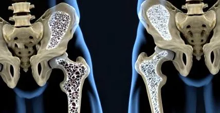 coxarthrosis csípőízületre