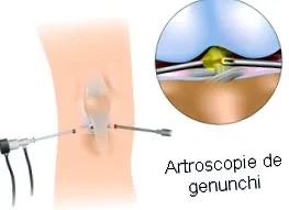 arthroscopy