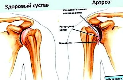 става тазобедрената